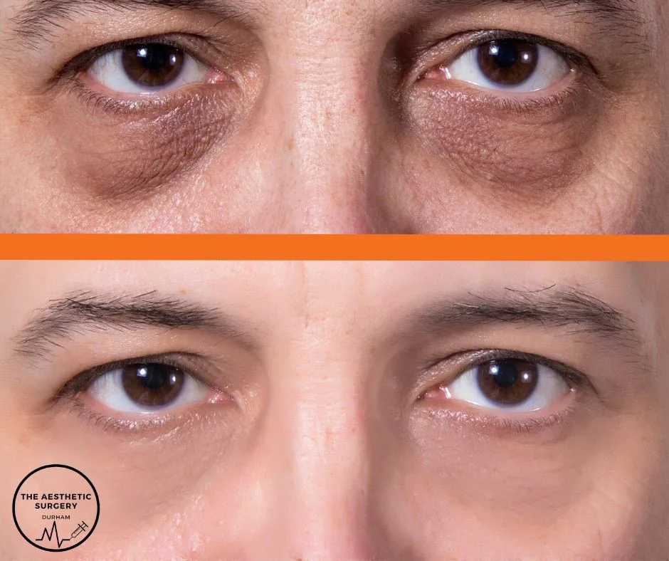 Picture shows before and after of Matrix Eye Treatment