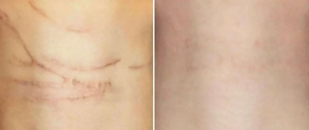Self harm scars from a male patient. Showing before and after Microneedling conduction therapy | The Aesthetic Surgery Durham | Microneedling