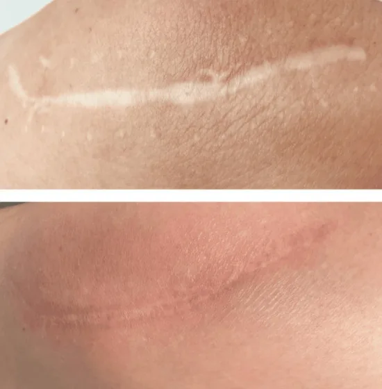 Self Harm Scars before and after from a female patient from microneedling conduction therapy | The Aesthetic Surgery Durham | Microneedling