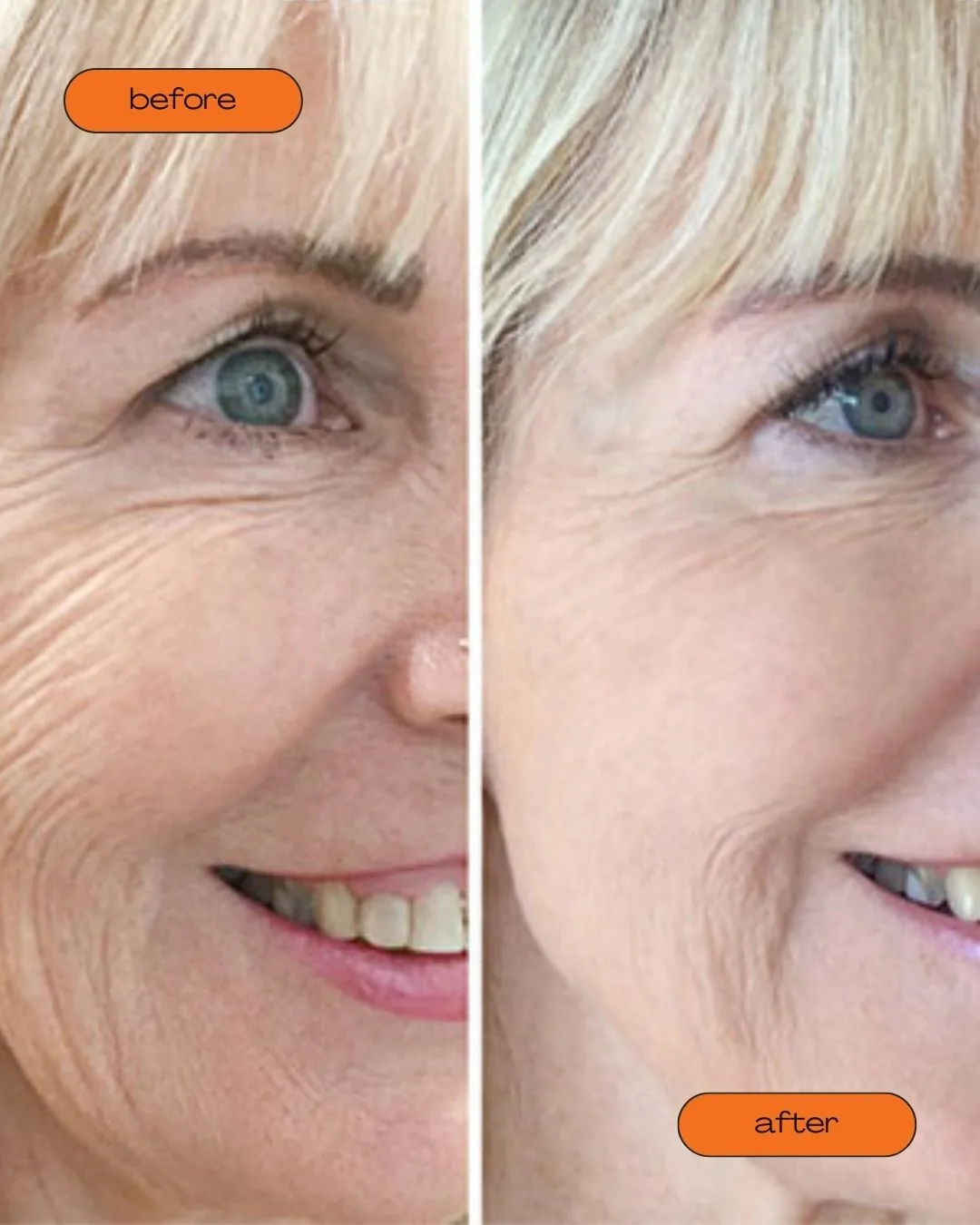 Before and After photo of a client having our skin booster. The Aesthetic Surgery | Durham