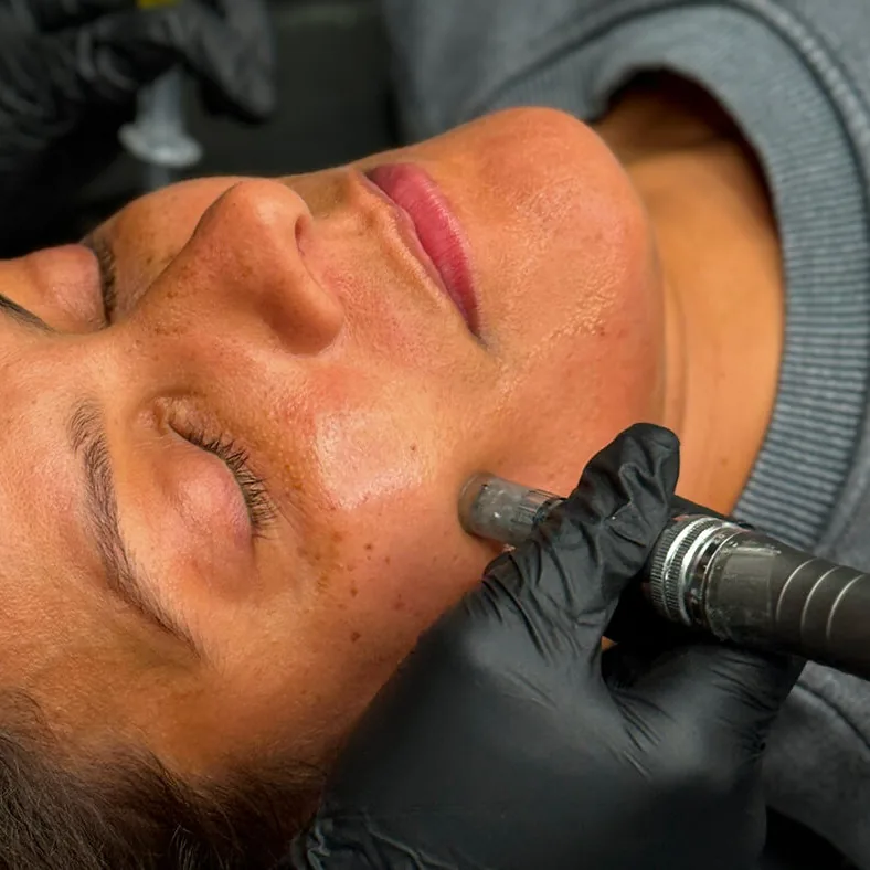Lee Microneedling one of his clients.