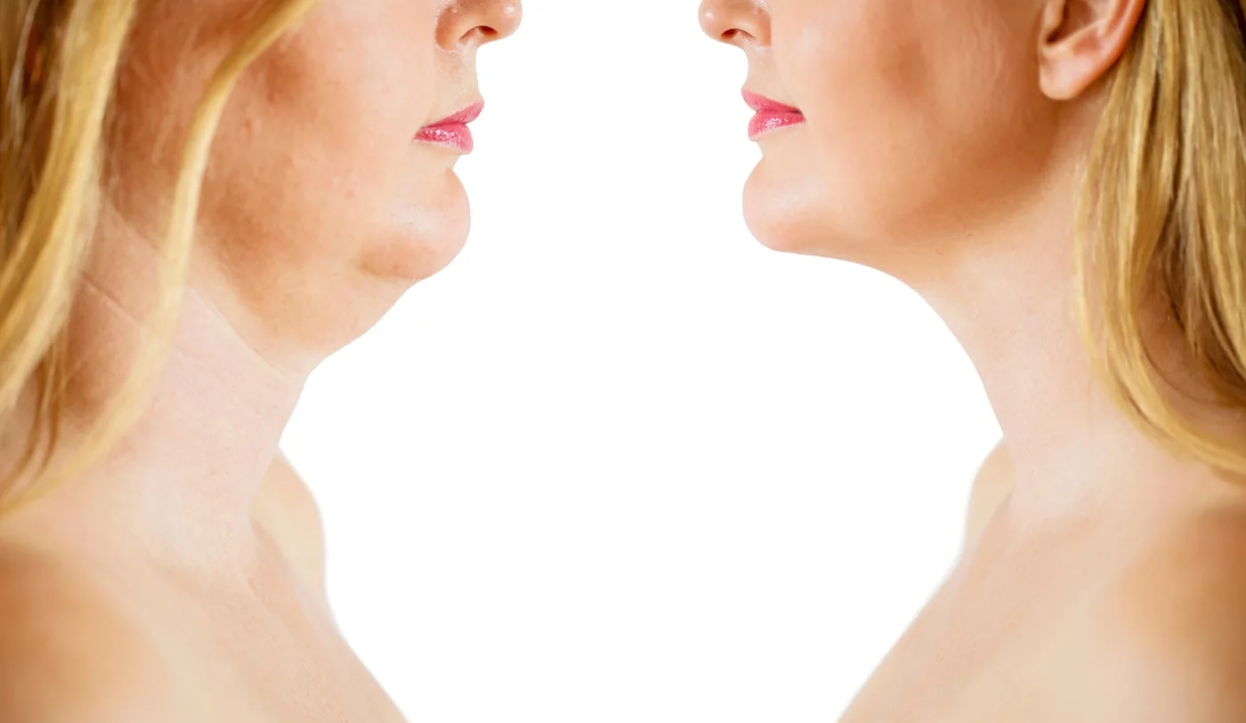 Before and after fat dissolving injections on a female patients chin | The Aesthetic Surgery | Fat Dissolving Durham