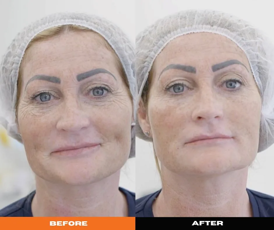 8 point natural facelift