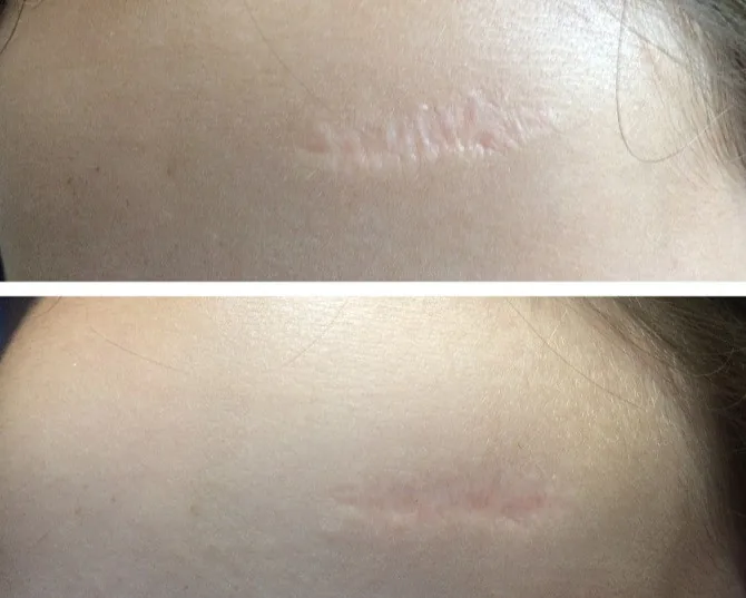 Accidental scar on female forhead. Before and after Microneedling conduction therapy | The Aesthetic Surgery Durham | Microneedling