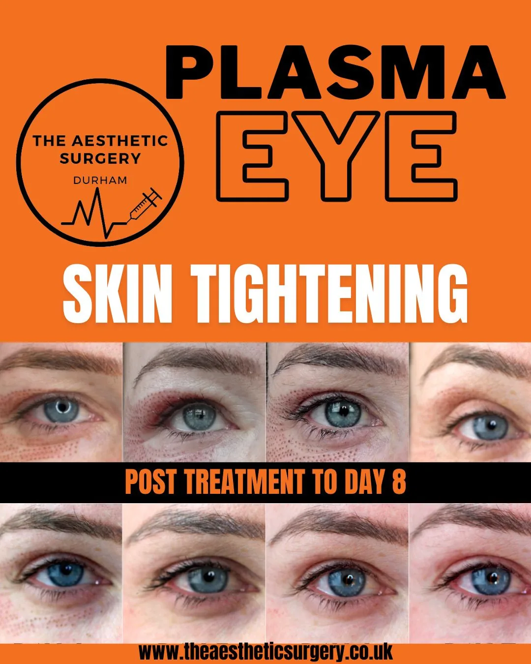 Plasma Skin Stightening | Eyes | The Aesthetic Surgery | Durham